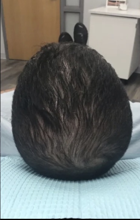 Client scalp after hair loss treatment at Juvly Aesthetics