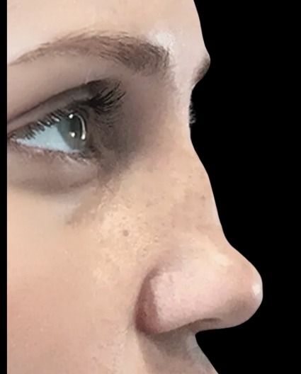 Liquid Nose Job before treatment at Juvly Aesthetics