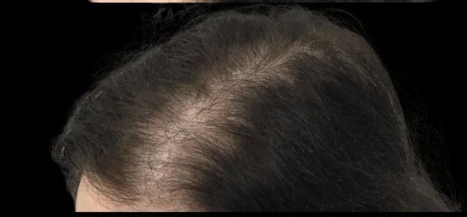 Client scalp after hair loss treatment at Juvly Aesthetics