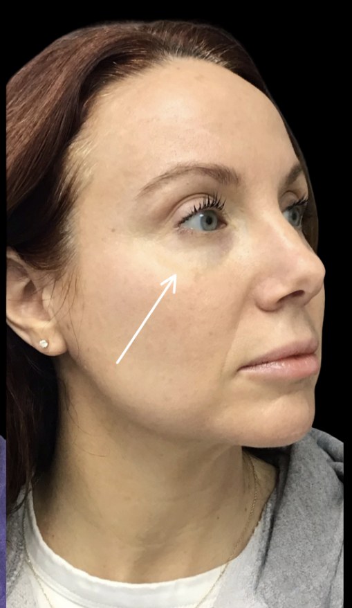 Standard Microneedling after treatment at Juvly Aesthetics