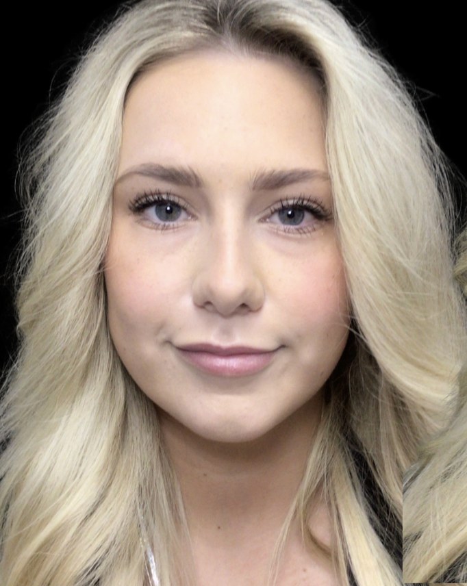 Lip filler before treatment at Juvly Aesthetics