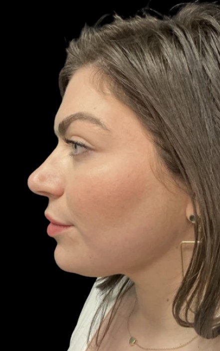 Kybella after treatment at Juvly Aesthetics