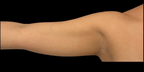 CoolSculpting after treatment at Juvly Aesthetics