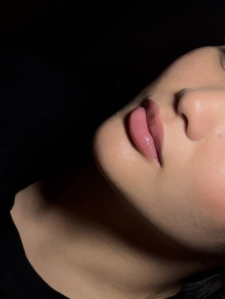 Lip Filler