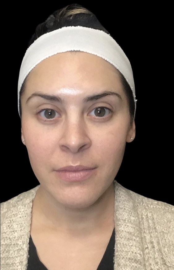 Client after wrinkle relaxer treatment at Juvly Aesthetics