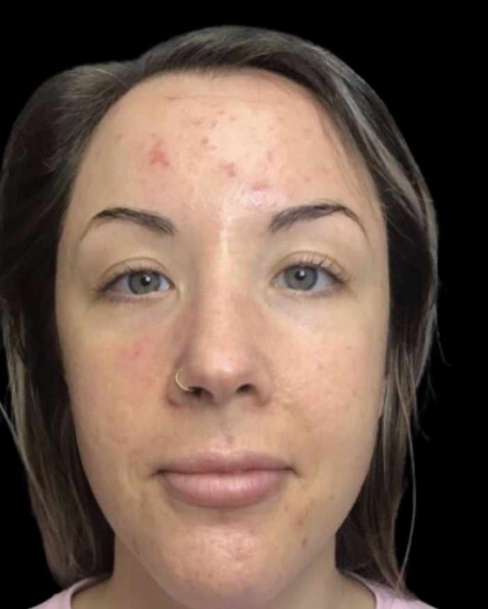 Chemical Peel before treatment at Juvly Aesthetics