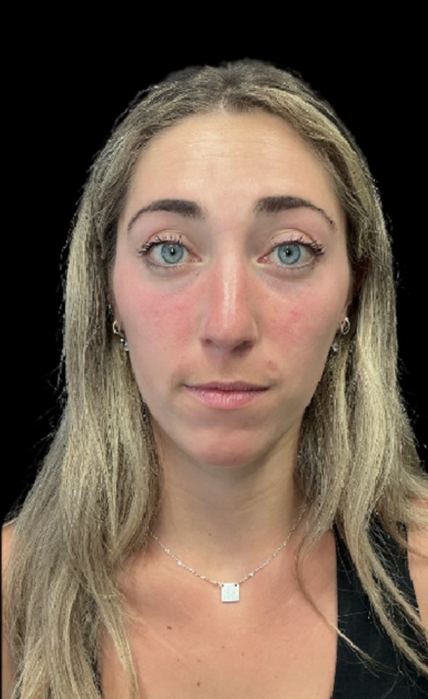 Client before wrinkle relaxer treatment at Juvly Aesthetics