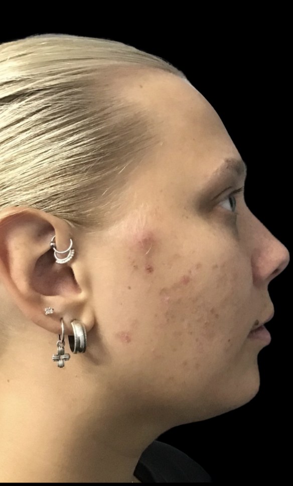Standard Microneedling before treatment at Juvly Aesthetics
