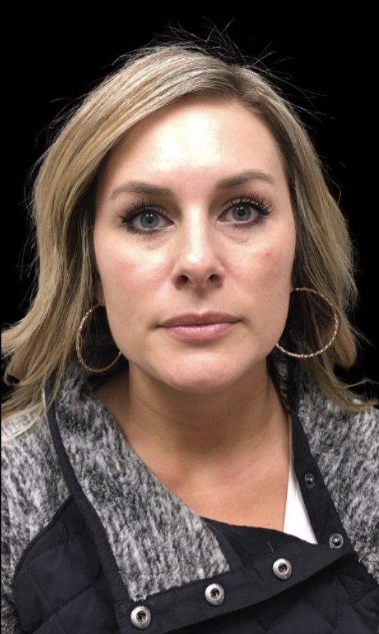 JLyft Non-Surgical Facelift before treatment at Juvly Aesthetics