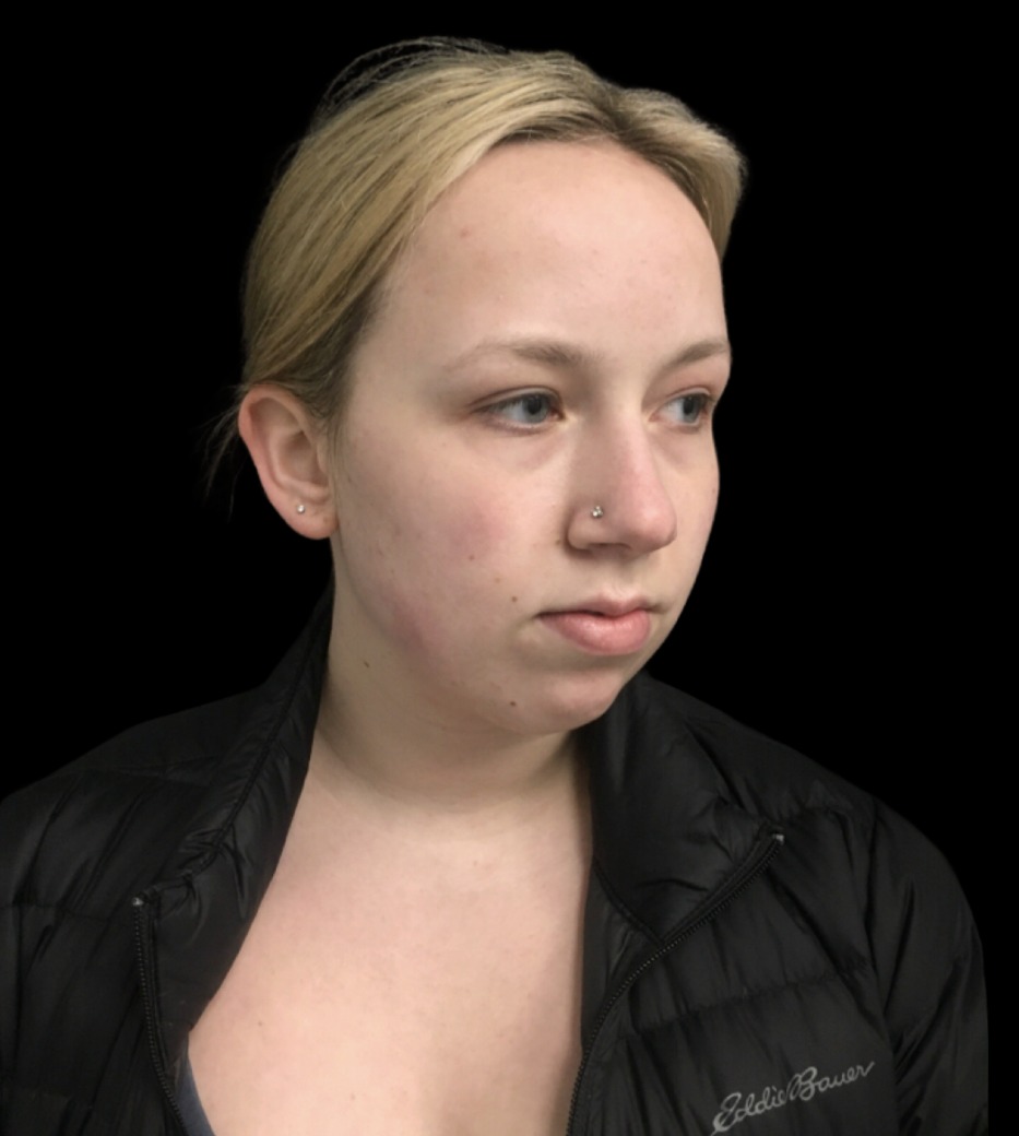 Chin Filler before treatment at Juvly Aesthetics