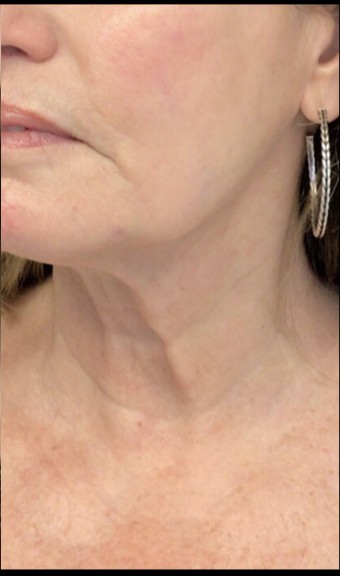Sylfirm X after treatment at Juvly Aesthetics