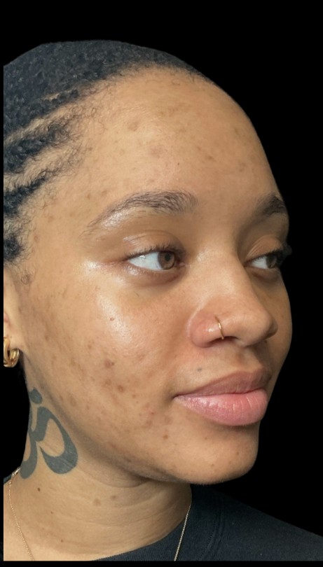 Chemical Peel after treatment at Juvly Aesthetics
