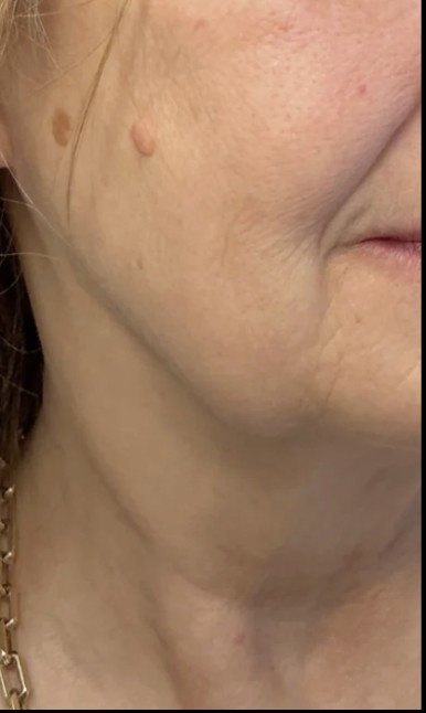 
 after treatment stacking at Juvly Aesthetics