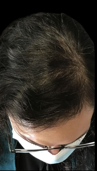 Client scalp after hair loss treatment at Juvly Aesthetics