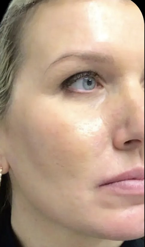 Standard Microneedling after treatment at Juvly Aesthetics