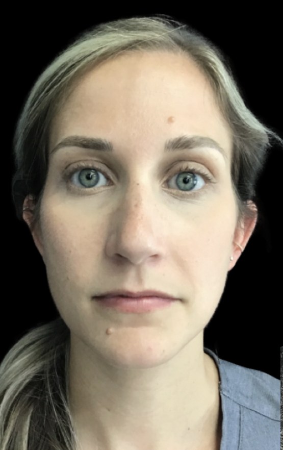 JLyft Non-Surgical Facelift before treatment at Juvly Aesthetics