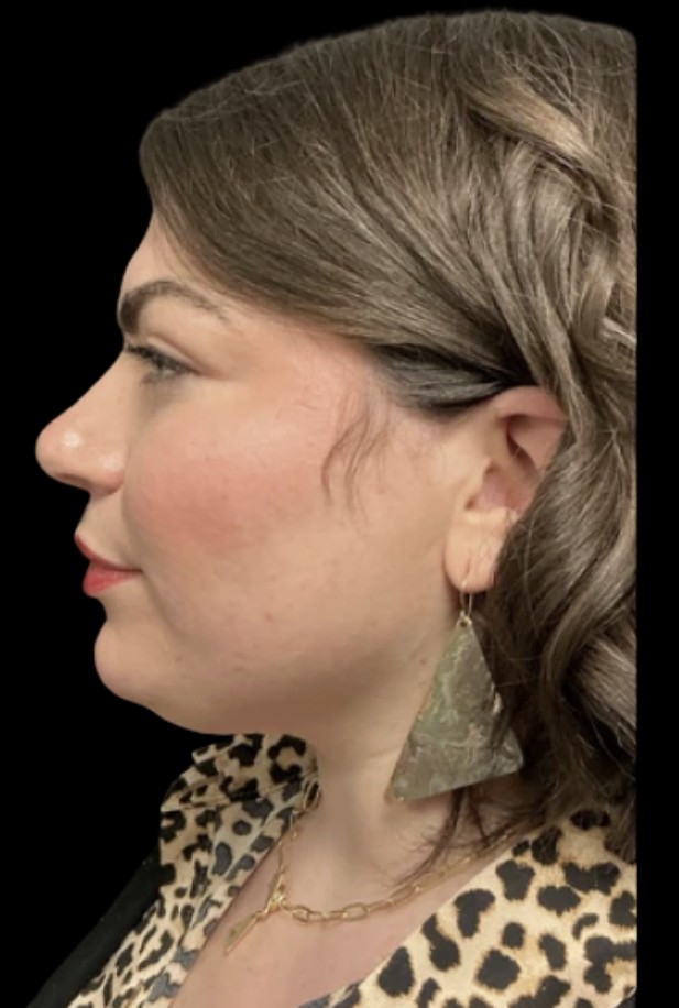 Kybella before treatment at Juvly Aesthetics