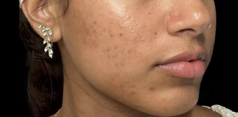 Standard Microneedling before treatment at Juvly Aesthetics