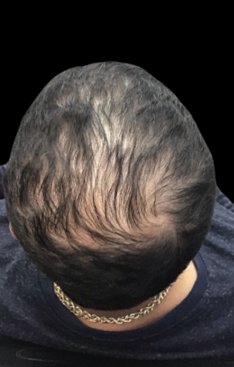 Client scalp before hair loss treatment at Juvly Aesthetics
