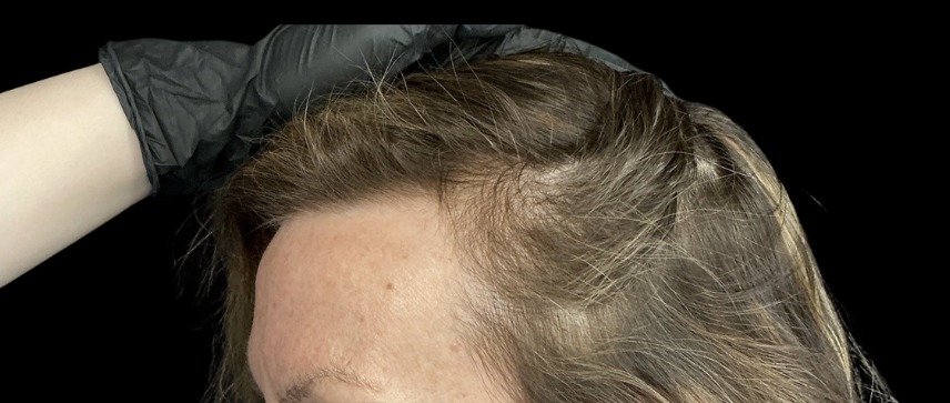 Hair Loss Treatments before treatment at Juvly Aesthetics