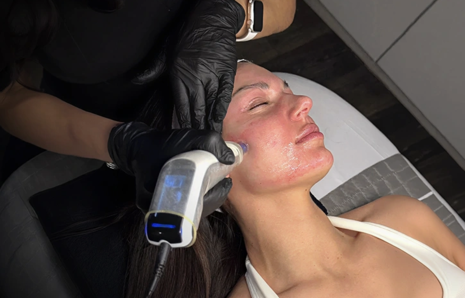 Standard microneedling treatment along the jawline at Juvly