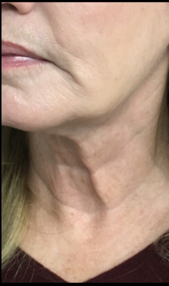 Sylfirm X before treatment at Juvly Aesthetics