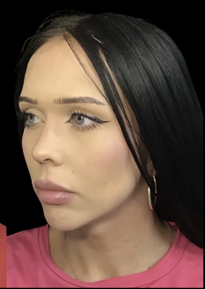 Chin Filler after treatment at Juvly Aesthetics