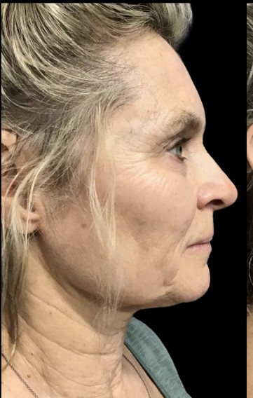 Sylfirm X before treatment at Juvly Aesthetics