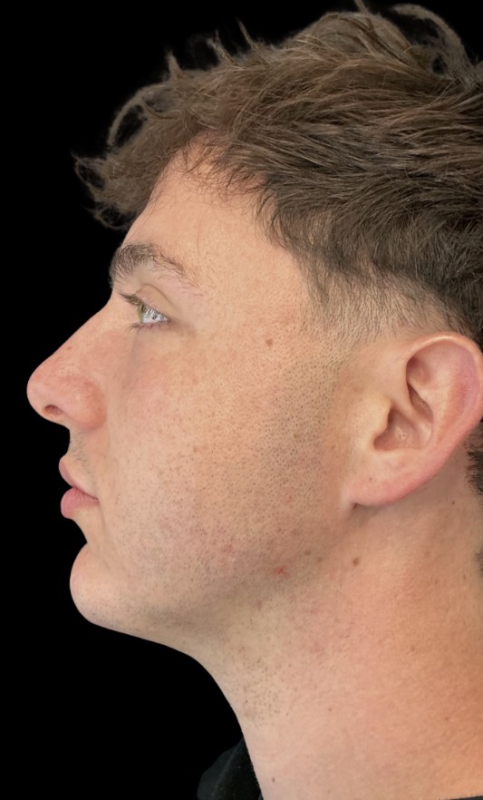 JLyft Non-Surgical Facelift after treatment at Juvly Aesthetics