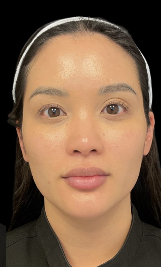 JLyft Non-Surgical Facelift after treatment at Juvly Aesthetics