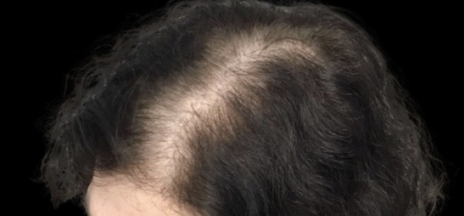 Client scalp before hair loss treatment at Juvly Aesthetics