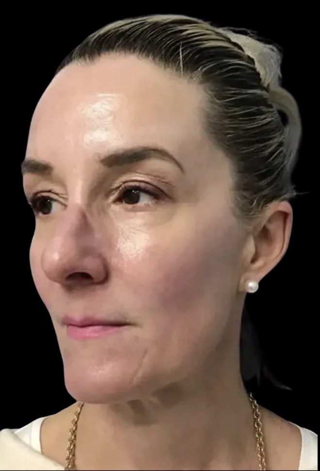 Standard Microneedling after treatment at Juvly Aesthetics