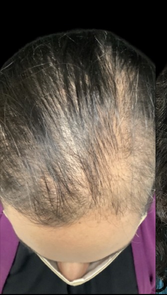 Client scalp before hair loss treatment at Juvly Aesthetics