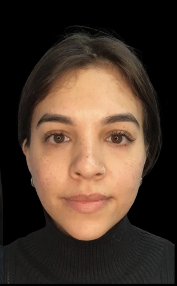 Cheek Filler after treatment at Juvly Aesthetics