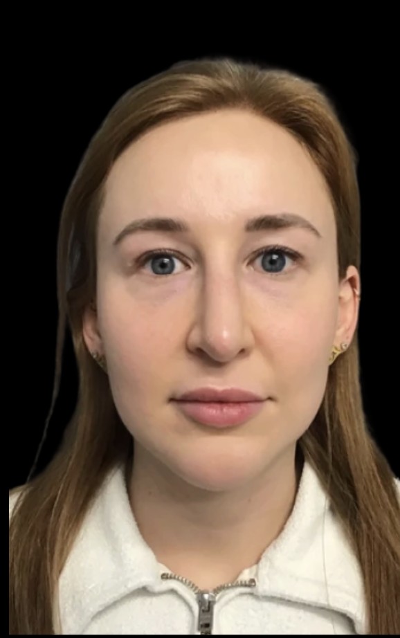 Under-Eye Treatments before treatment at Juvly Aesthetics