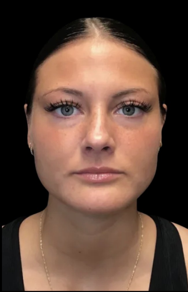 Masseter slimming before treatment at Juvly Aesthetics