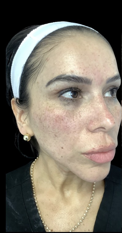 Sylfirm X before treatment at Juvly Aesthetics