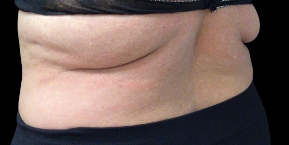 CoolSculpting before treatment at Juvly Aesthetics