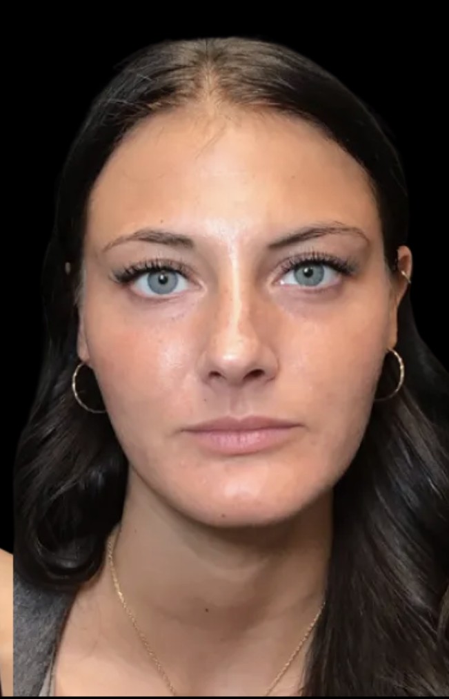 Masseter slimming after treatment at Juvly Aesthetics