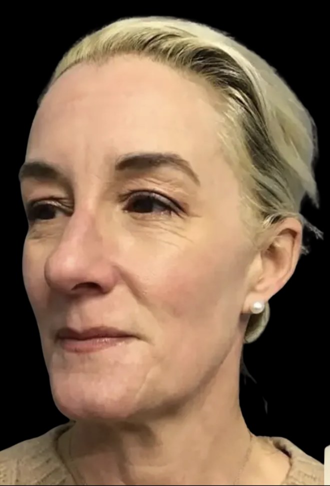 Standard Microneedling before treatment at Juvly Aesthetics