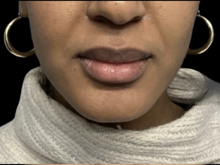 Lip filler before treatment at Juvly Aesthetics
