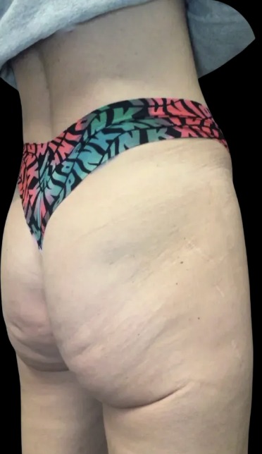Non-Surgical BBL after treatment at Juvly Aesthetics