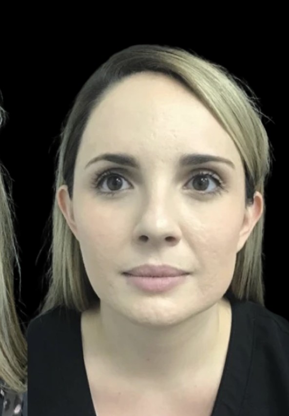 Masseter Slimming after treatment at Juvly Aesthetics