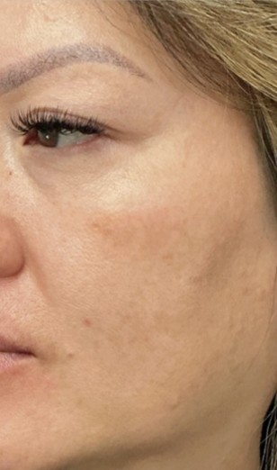 Chemical Peel after treatment at Juvly Aesthetics