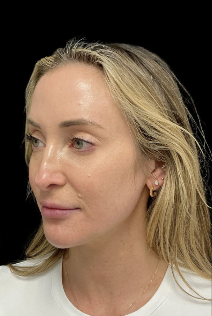Laser after treatment at Juvly Aesthetics