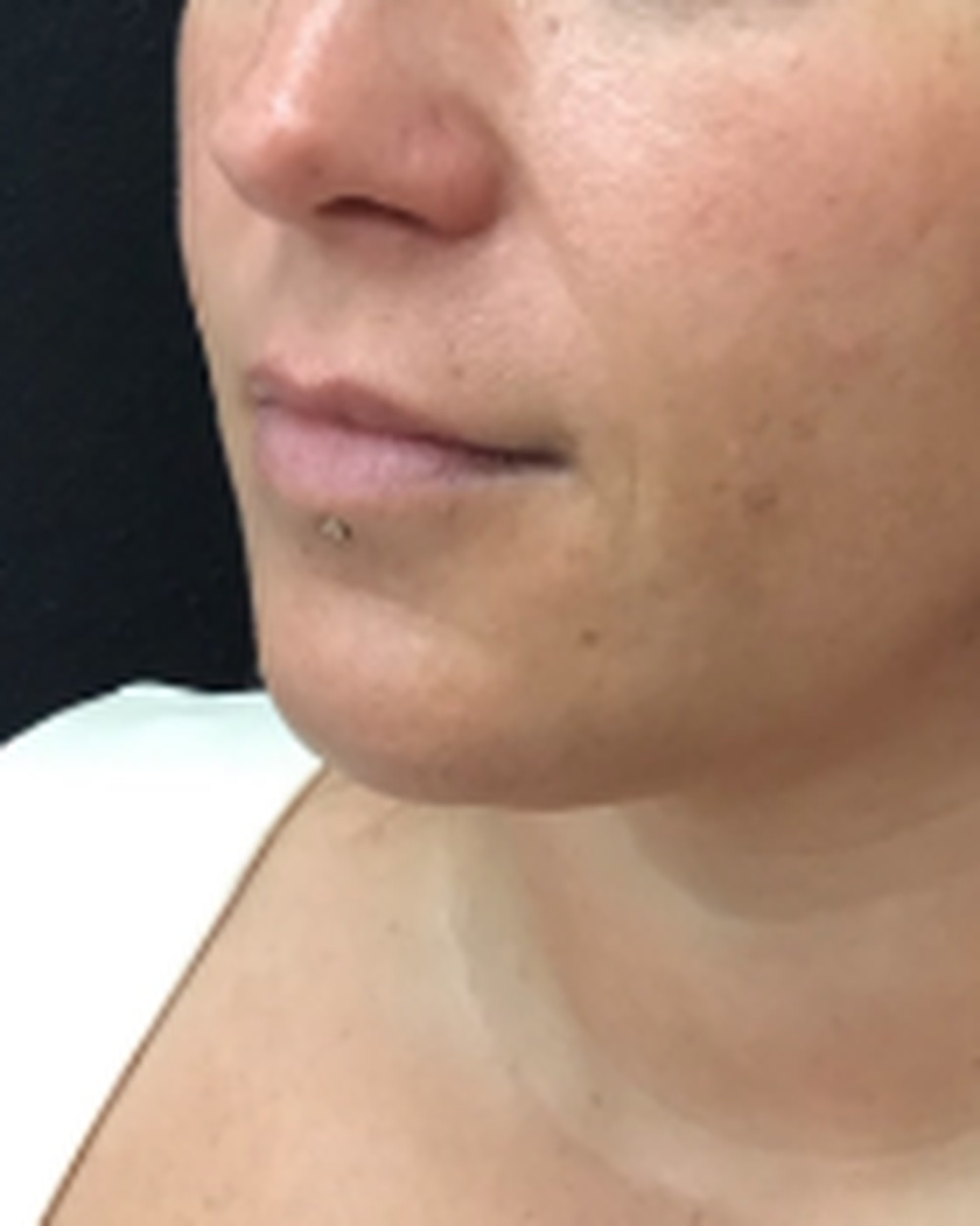 Lip filler before treatment at Juvly Aesthetics