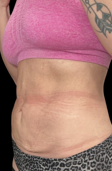 
 before treatment stacking at Juvly Aesthetics
