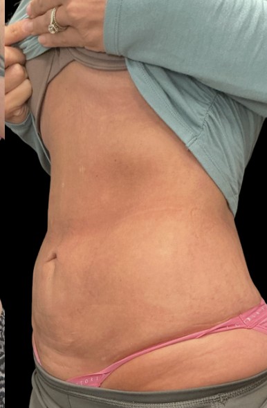 
 after treatment stacking at Juvly Aesthetics