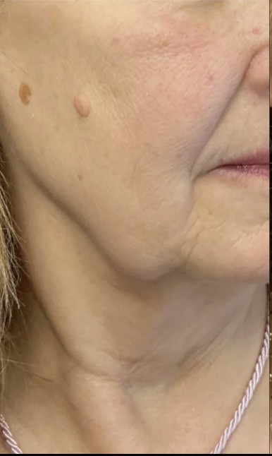 
 before treatment stacking at Juvly Aesthetics