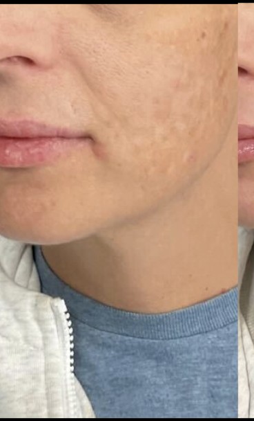 Chemical Peel before treatment at Juvly Aesthetics
